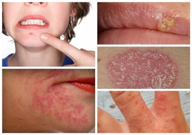 Alergie i choroby skóry to oznaki pasożytów w organizmie