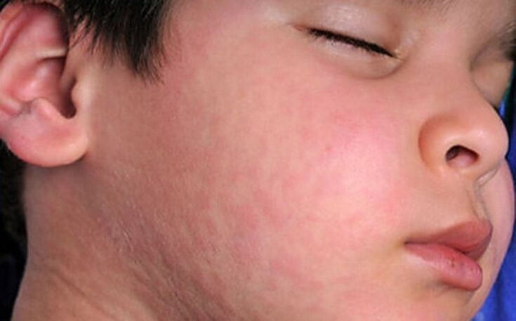 Wysypki alergiczne na skórze - objaw obecności pasożytniczych robaków w ciele